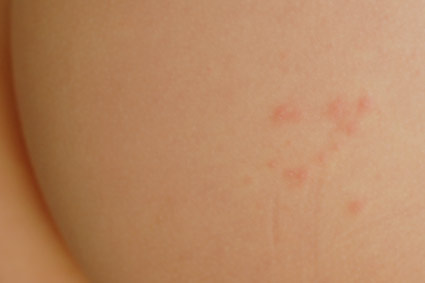 Dermatitis herpetiformis Symptoms, Treatment, Pictures ...