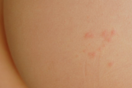 dermatitis herpetiformis op de bil