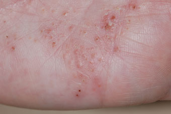 Ringworm In Babies And Children: Treatment And Prevention ...