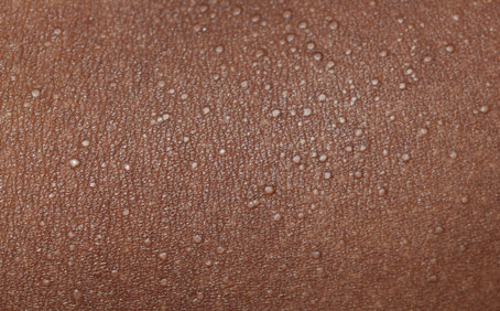 lichen nitidus bij
                                                de gepigmenteerde huid