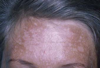 [Afbeelding: melasma.jpg]