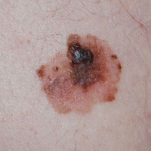 Seborrhoeic dermatitis - Wikipedia