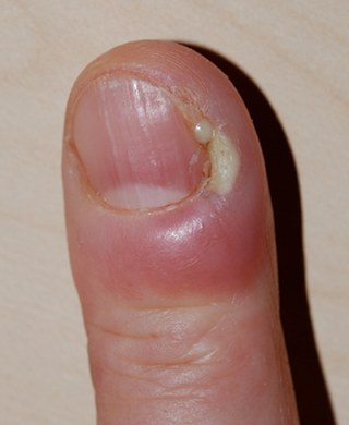 Finger Infection Pictures, Treatments & Home Remedies