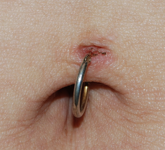 Gedeeltelijk
                                          uitgescheurde piercing met
                                          infectie van de huid.