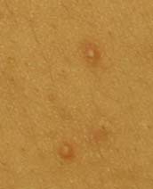 pityrosporum folliculitis picture #11