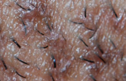 pseudofolliculitis
                                                          in de
                                                          baardstreek:
                                                          ingegroeide
                                                          haren zijn te
                                                          zien.