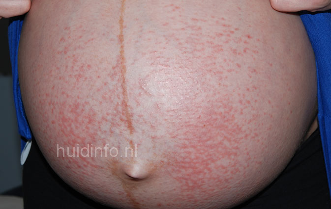 pupp pregnancy rash #11