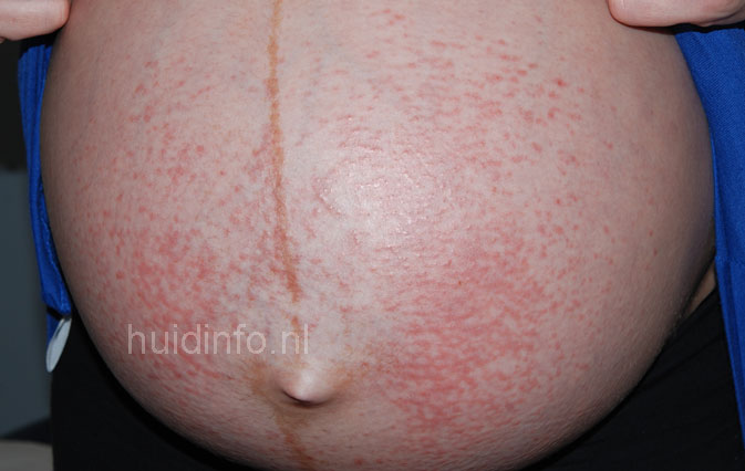 herpes on stomach photos