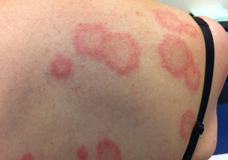 Pictures of Skin Rashes [Slideshow] - LoveToKnow