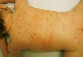 urticaria
                                pigmentosa komt vooral bij kinderen
                                voor.