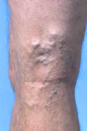 Phlebitis Images - Photos - Pictures - Page 2