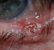 basaalcelcarcinoom
                                          oogrand