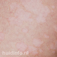 Pityriasis alba