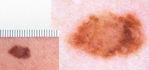 dermatoscopie dermatoscoop melanoom moedervlek